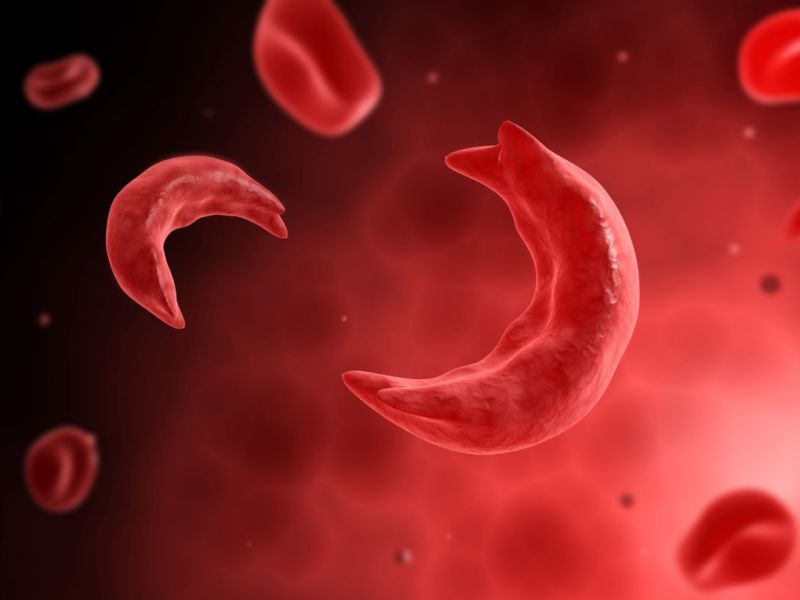 Harvesting Health and Reaping Profits: The $2.2 Million Cure for Sickle-Cell Disease 